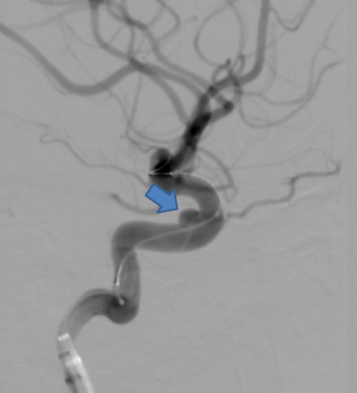 Bệnh viện HNĐK Nghệ An thực hiện đặt Stent chuyển dòng chảy điều trị phình động mạch não- Ảnh 2.