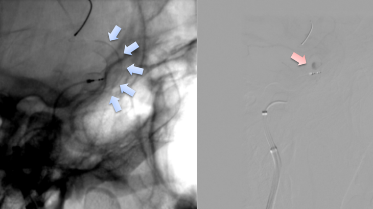 Bệnh viện HNĐK Nghệ An thực hiện đặt Stent chuyển dòng chảy điều trị phình động mạch não- Ảnh 3.