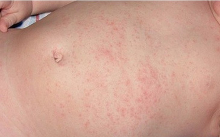 Rôm sảy: Nguyên nhân, triệu chứng, phòng ngừa và điều trị- Ảnh 2. Rôm sảy: Nguyên nhân, triệu chứng, phòng ngừa và điều trị- Ảnh 2.