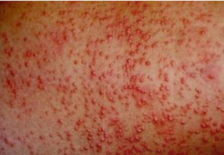 Rôm sảy: Nguyên nhân, triệu chứng, phòng ngừa và điều trị- Ảnh 3. Rôm sảy: Nguyên nhân, triệu chứng, phòng ngừa và điều trị- Ảnh 3.