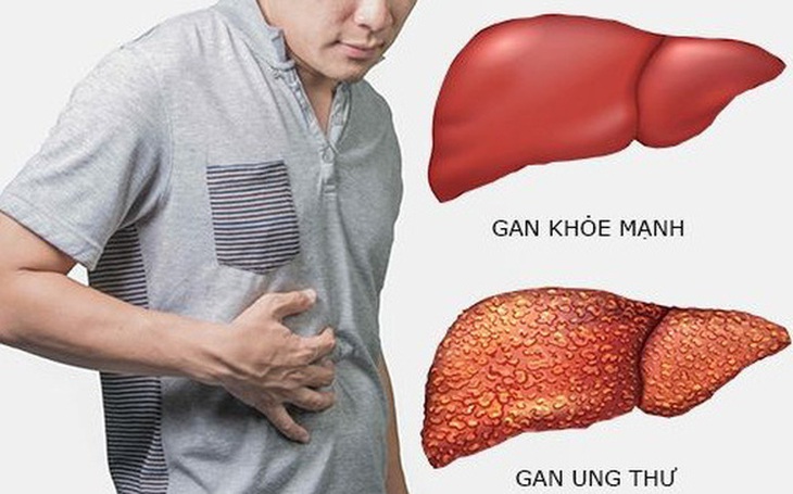 Ung thư gan có mấy giai đoạn?- Ảnh 1.