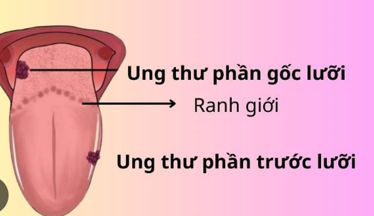 Người bệnh ung thư lưỡi nên tập luyện như thế nào?- Ảnh 1. Người bệnh ung thư lưỡi nên tập luyện như thế nào?- Ảnh 1.