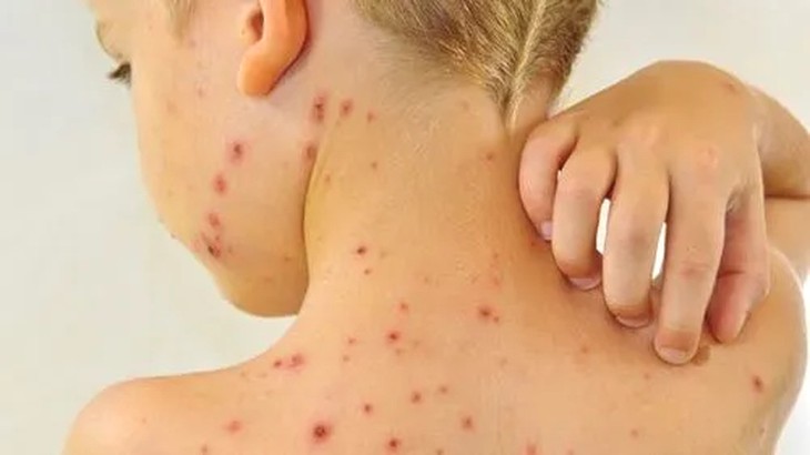 Cứu sống 2 trẻ sơ sinh nguy kịch do bị thủy đậu toàn thân- Ảnh 2.