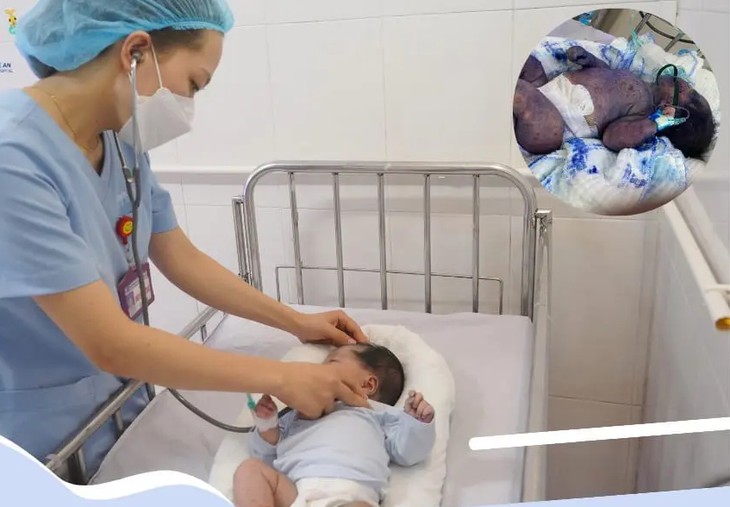 Cứu sống 2 trẻ sơ sinh nguy kịch do bị thủy đậu toàn thân- Ảnh 1.