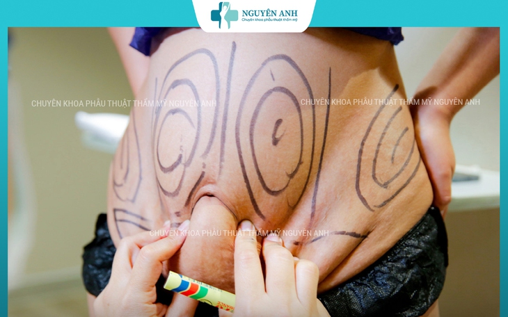 Nhồi máu não diện rộng sau hút mỡ tại Viện thẩm mỹ Nguyên Anh