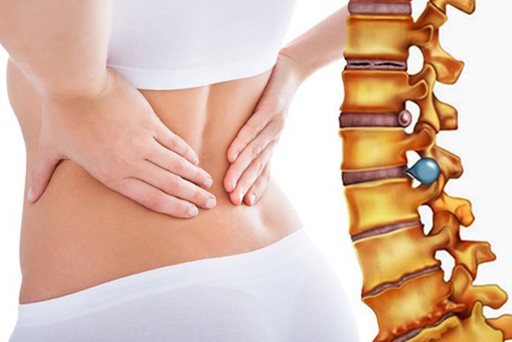 Những lưu ý không thể bỏ qua cho người bị thoát vị đĩa đệm- Ảnh 2.