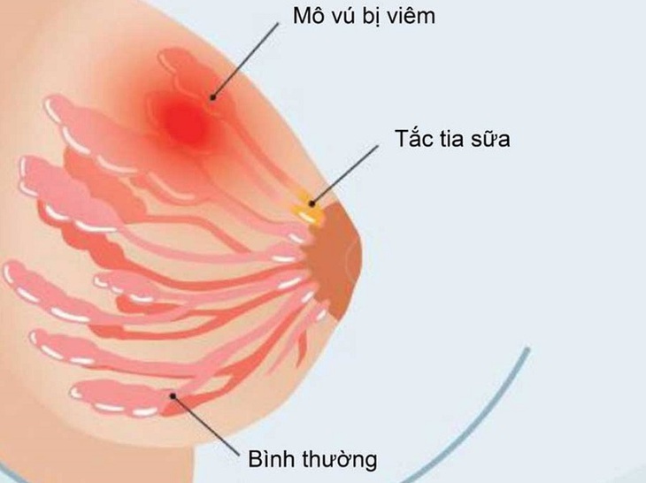 Những biến chứng phổ biến ở vú khi cho con bú, mẹ mới sinh cần lưu ý- Ảnh 3.