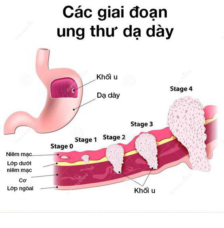 Người đàn ông tử vong sau 3 tuần uống nước kiềm chữa ung thư dạ dày, bệnh này điều trị thế nào?- Ảnh 1.