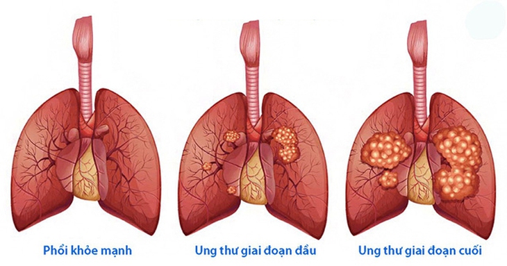 NHỮNG DẤU HIỆU CẢNH BÁO BỆNH UNG THƯ PHỔI BẠN CẦN LƯU Ý
