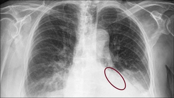 Câu hỏi liên quan đến bệnh tràn dịch màng phổi- Ảnh 1.