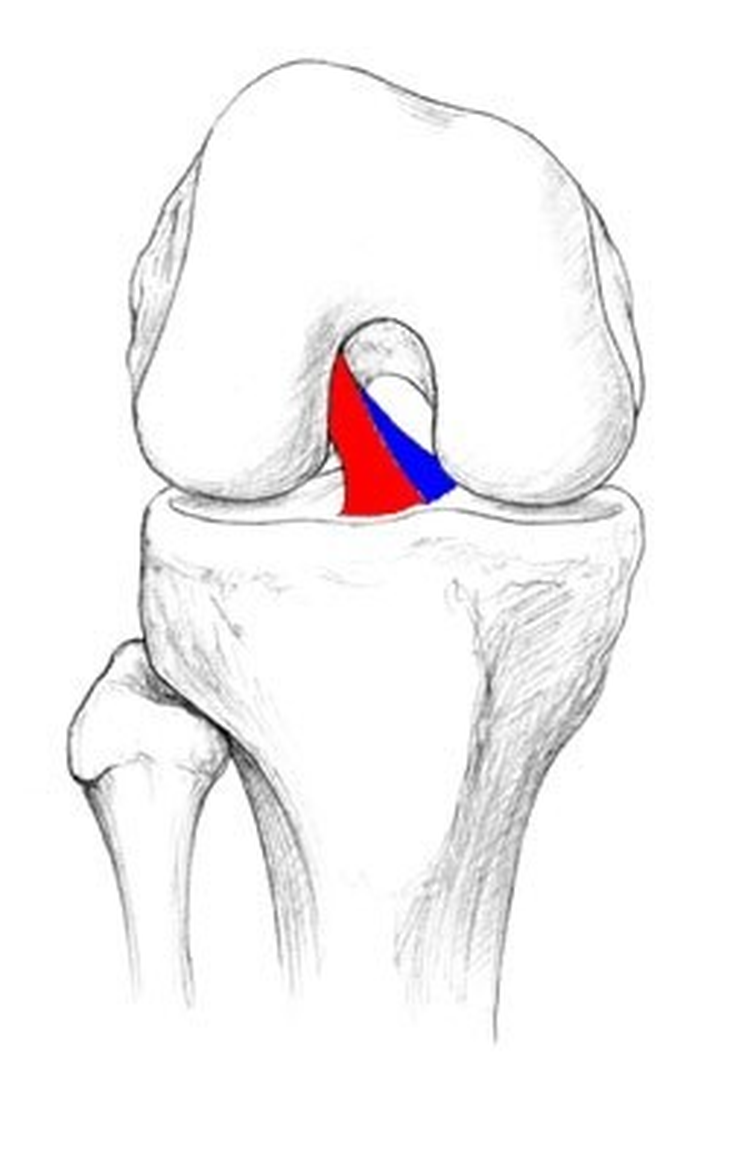 Đứt bán phần dây chằng chéo trước - giải pháp hồi phục nhanh- Ảnh 2.