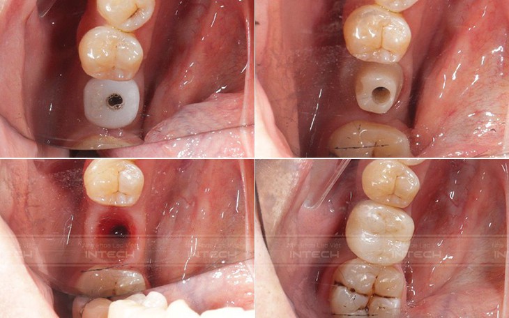 Giải pháp trồng răng implant cá nhân hóa DCT - Xu hướng trồng răng thế kỷ XXI- Ảnh 2.