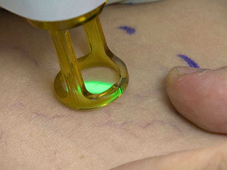 Điều trị giãn tĩnh mạch: Lý do bắn laser hoặc tiêm xơ chưa đem lại hiệu quả lâu dài- Ảnh 1.