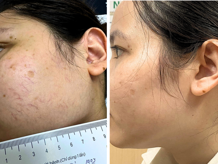 Điều trị giãn tĩnh mạch: Lý do bắn laser hoặc tiêm xơ chưa đem lại hiệu quả lâu dài- Ảnh 2.