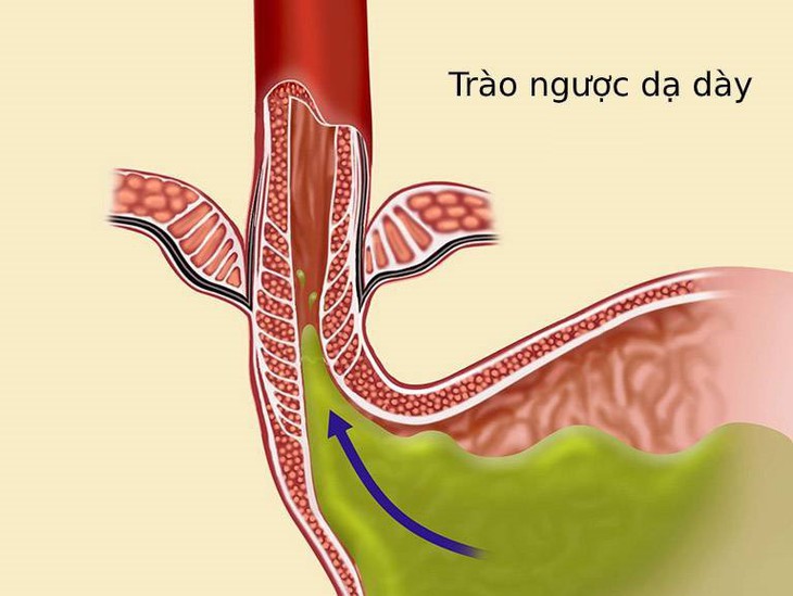 Trào ngược dạ dày thực quản (GERD) hay gọi là trào ngược dạ dày là một bệnh lý về đường tiêu hóa rất phổ biến tại Việt Nam. Trào ngược dạ dày thực quản (GERD) hay gọi là trào ngược dạ dày là một bệnh lý về đường tiêu hóa rất phổ biến tại Việt Nam.