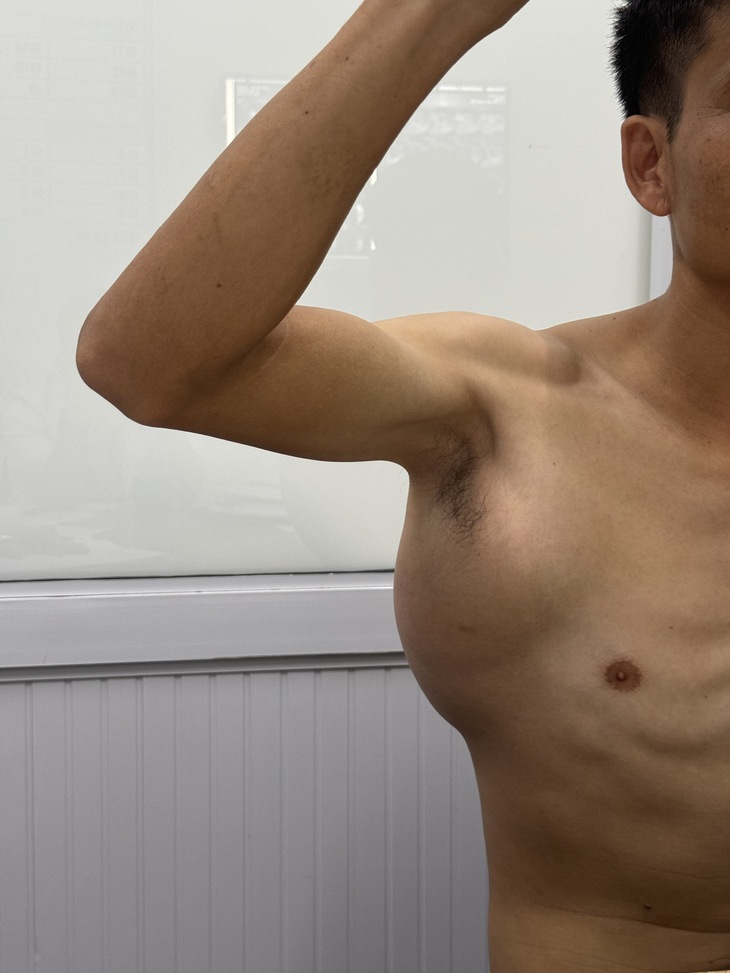 U máu: Nguyên nhân, triệu chứng, phòng ngừa và điều trị- Ảnh 2.