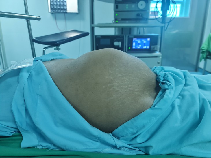 Bụng to như thai 8 tháng, bất ngờ hút ra 4,5 lít mủ- Ảnh 2. Bụng to như thai 8 tháng, bất ngờ hút ra 4,5 lít mủ- Ảnh 2.
