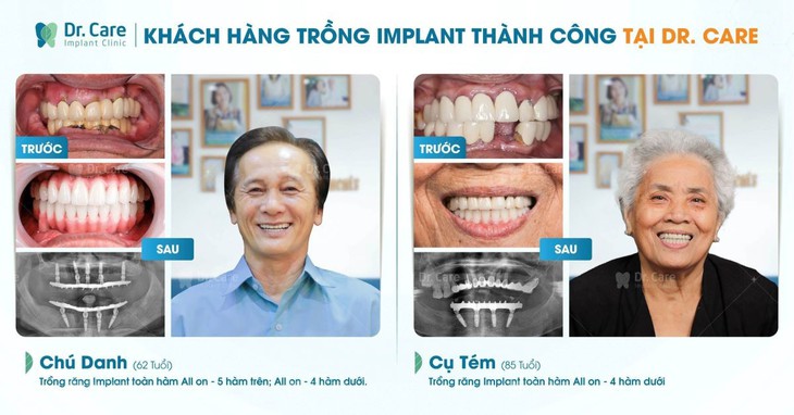 Nha khoa chuyên sâu trồng răng Implant tại TP.HCM dành cho người trung niên- Ảnh 1. Nha khoa chuyên sâu trồng răng Implant tại TP.HCM dành cho người trung niên- Ảnh 1.