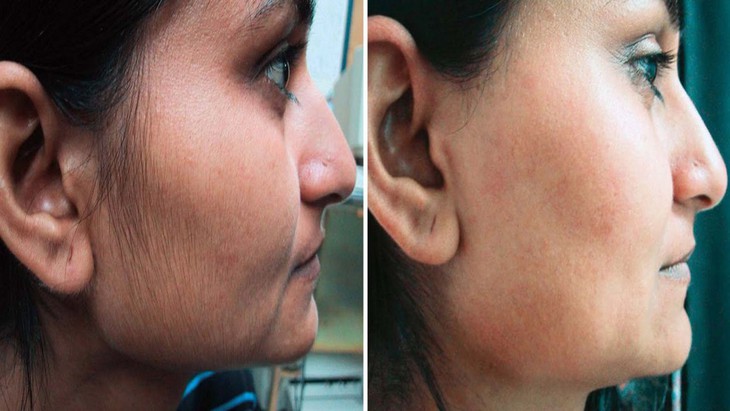 Thuốc điều trị bệnh rậm lông- Ảnh 3.