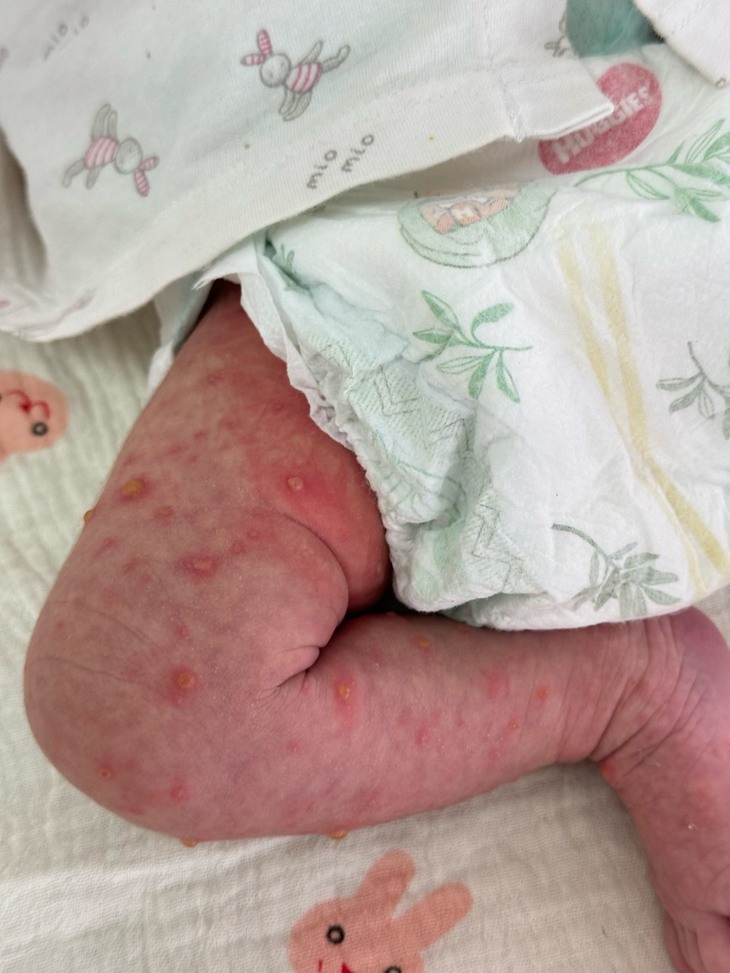 Bé 5 ngày tuổi toàn thân nổi mụn nước vì lây bệnh truyền nhiễm từ mẹ- Ảnh 3. Bé 5 ngày tuổi toàn thân nổi mụn nước vì lây bệnh truyền nhiễm từ mẹ- Ảnh 3.