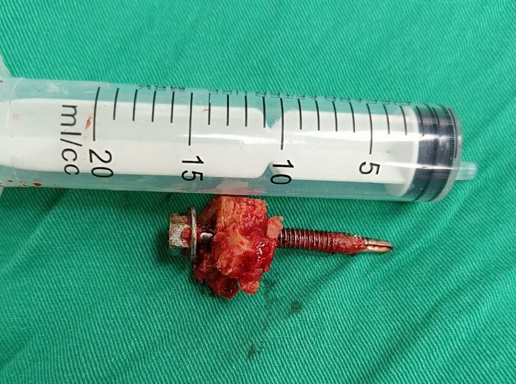 Xót xa bệnh nhân trầm cảm tự đóng đinh sắt vào đầu- Ảnh 2. Xót xa bệnh nhân trầm cảm tự đóng đinh sắt vào đầu- Ảnh 2.