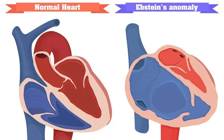 Tim bẩm sinh Ebstein: Nguyên nhân, triệu chứng, cách điều trị