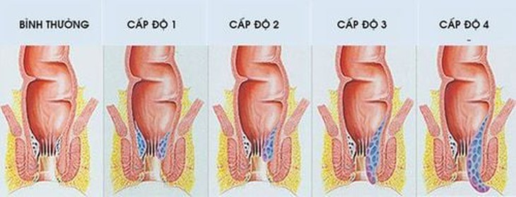 Trĩ nội độ 2 có cần mổ không?- Ảnh 1.