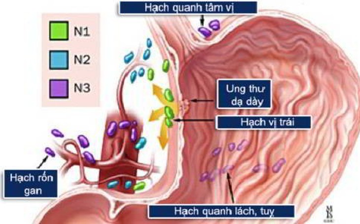 Ung thư dạ dày: Nguyên nhân, biểu hiện, cách điều trị và phòng bệnh