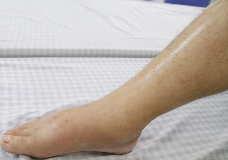 Phù toàn thân bởi nguyên nhân ai cũng có thể mắc phải- Ảnh 1.