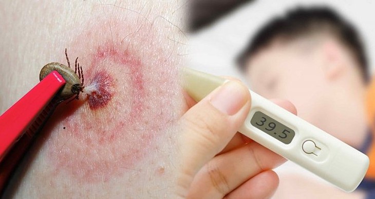 Suy đa tạng do mò đốt, đặc trưng của bệnh sốt mò cần biết- Ảnh 1.