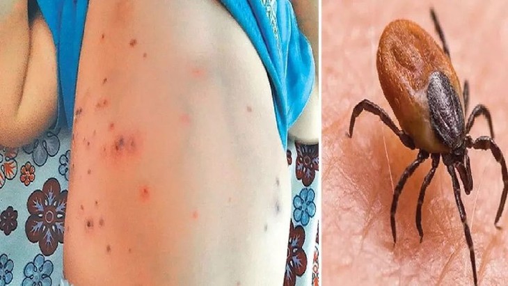 Sốt ve mò: Nguyên nhân, triệu chứng và phương pháp điều trị- Ảnh 1.
