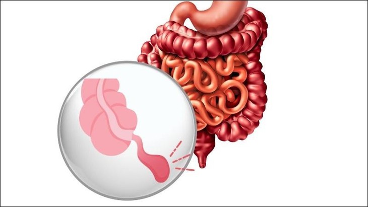 Viêm ruột thừa cấp là biểu hiện tình trạng bệnh lý bất thường của ruột thừa. Viêm ruột thừa cấp là biểu hiện tình trạng bệnh lý bất thường của ruột thừa.