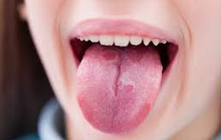 Bạch sản niêm có tiến triển thành ung thư?- Ảnh 1.