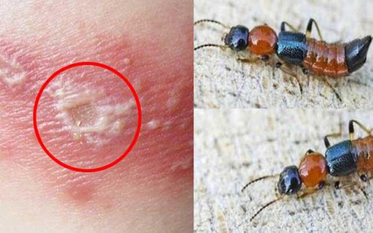 Kiến ba khoang 'tấn công' khiến người đàn ông bị sốc phản vệ - Ảnh 2.