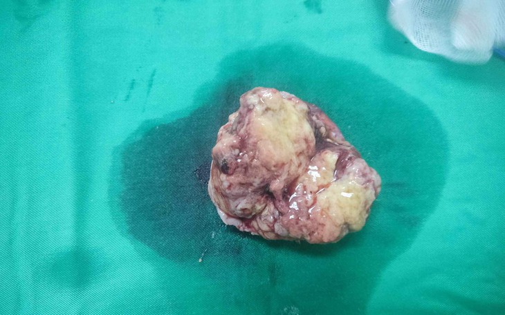 Ung thư tinh hoàn: Nguyên nhân, triệu chứng, phòng ngừa và điều trị