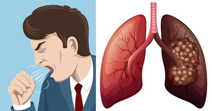 Ung thư phổi cũng có thể làm thay đổi giọng nói của một người, khiến khàn đặc.