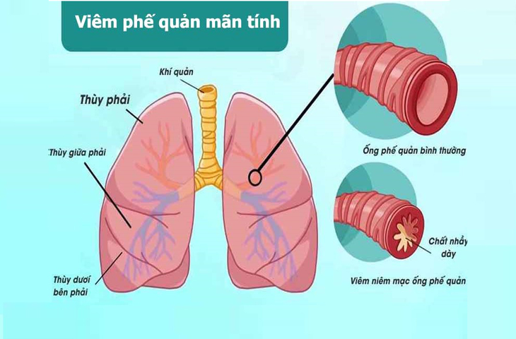 Viêm phế quản mạn tính: Dấu hiệu nhận biết và cách xử lý- Ảnh 1.