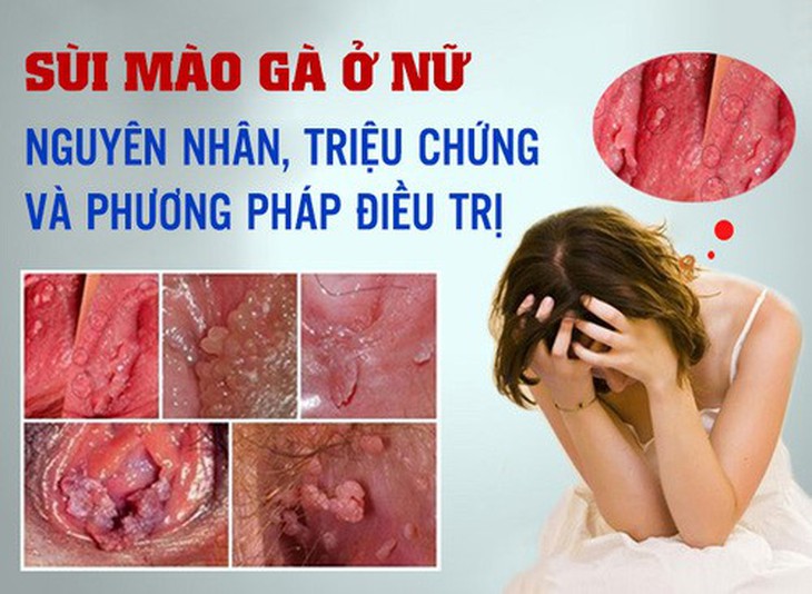 Bệnh sùi mào gà ở nữ giới: Nguyên nhân, dấu hiệu cách chữa- Ảnh 1. Bệnh sùi mào gà ở nữ giới: Nguyên nhân, dấu hiệu cách chữa- Ảnh 1.