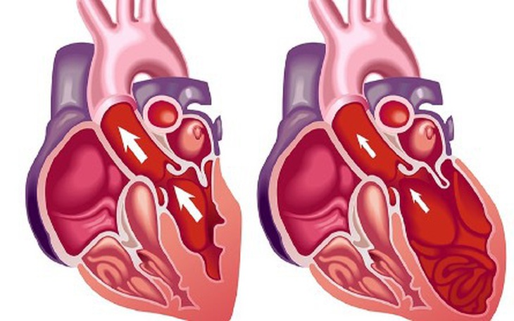 Suy tim trái: Nguyên nhân, triệu chứng, cách điều trị và phòng bệnh