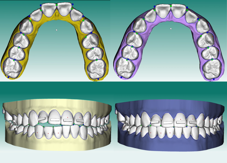 Phòng khám nha khoa tại Cẩm Phả điều trị thành công 15 ca chỉnh nha với khay trong suốt sau chuyển giao công nghệ cùng SingapoDent- Ảnh 2.