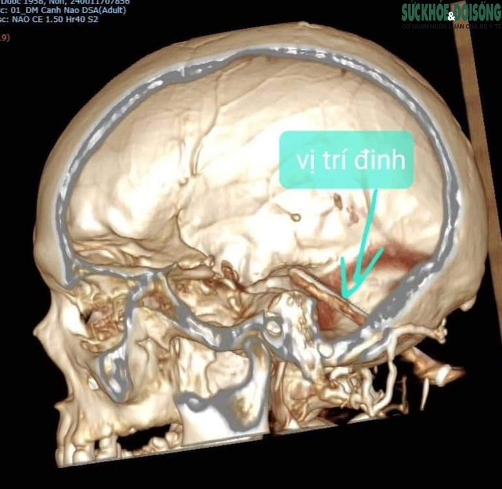 Hi hữu cây đinh dài nằm trong não người đàn ông hơn một năm - Ảnh 1. Hi hữu cây đinh dài nằm trong não người đàn ông hơn một năm - Ảnh 1.