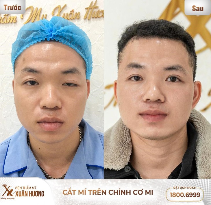 Cơ hội nhận quà tặng lên đến 800 triệu đồng tại workshop “Chỉnh cơ mi & giải cứu mí lỗi” của VTM Xuân Hương- Ảnh 2. Cơ hội nhận quà tặng lên đến 800 triệu đồng tại workshop “Chỉnh cơ mi & giải cứu mí lỗi” của VTM Xuân Hương- Ảnh 2.