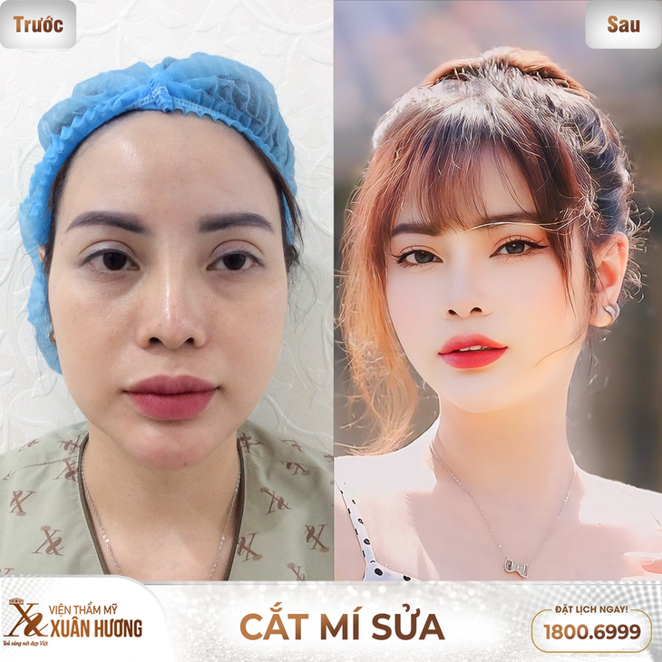 Cơ hội nhận quà tặng lên đến 800 triệu đồng tại workshop “Chỉnh cơ mi & giải cứu mí lỗi” của VTM Xuân Hương- Ảnh 3. Cơ hội nhận quà tặng lên đến 800 triệu đồng tại workshop “Chỉnh cơ mi & giải cứu mí lỗi” của VTM Xuân Hương- Ảnh 3.