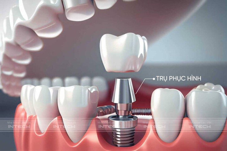 Chủ đề: Cùng tìm hiểu về trụ phục hình giải phẫu cá nhân hóa trong trồng răng implant công nghệ mới- Ảnh 1. Chủ đề: Cùng tìm hiểu về trụ phục hình giải phẫu cá nhân hóa trong trồng răng implant công nghệ mới- Ảnh 1.