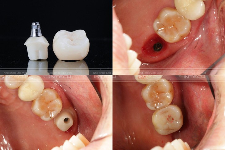 Chủ đề: Cùng tìm hiểu về trụ phục hình giải phẫu cá nhân hóa trong trồng răng implant công nghệ mới- Ảnh 3. Chủ đề: Cùng tìm hiểu về trụ phục hình giải phẫu cá nhân hóa trong trồng răng implant công nghệ mới- Ảnh 3.