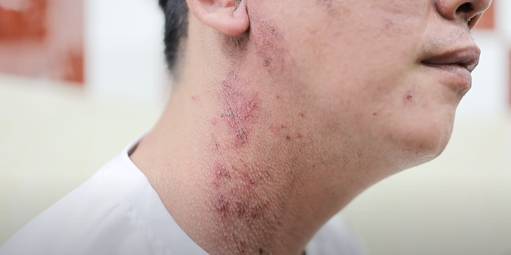 Người dân khổ sở vì mặt nổi sần mụn mủ, mắt sưng do kiến ba khoang- Ảnh 2.
