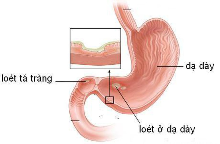 Quá trình viêm dạ dày diễn tiến chậm qua nhiều năm, qua nhiều giai đoạn trung gian với sự biến đổi tế bào của lớp áo phủ bên trong dạ dày trước khi hình thành ung thư dạ dày. Ảnh minh họa