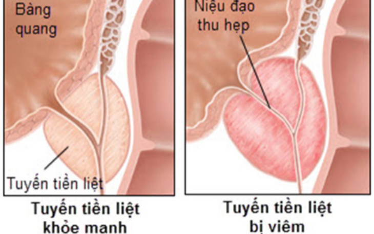 Viêm tuyến tiền liệt là gì, nguyên nhân, triệu chứng và cách chữa trị