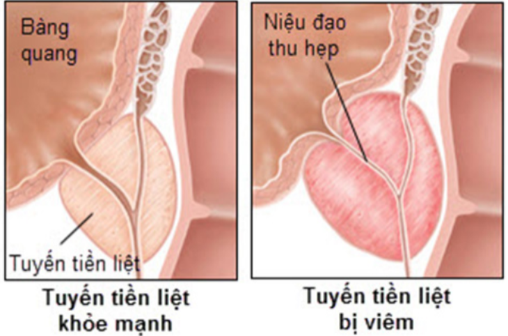 viêm tuyến tiền liệt