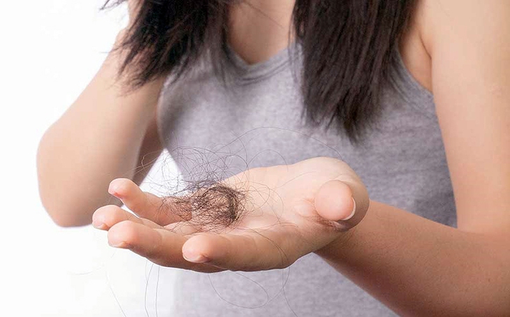 Nếu bệnh tuyến giáp nặng và không được điều trị có thể gây rụng tóc. Ảnh minh họa Nếu bệnh tuyến giáp nặng và không được điều trị có thể gây rụng tóc. Ảnh minh họa